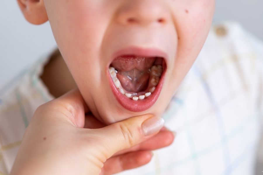 دواء لتسكين ألم الأسنان فورًا للاطفال